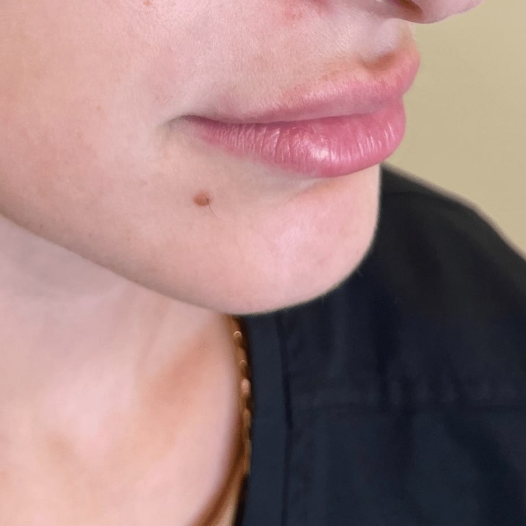 After Image: Lip Filler - right-front-oblique