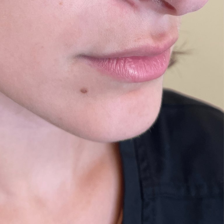 Before Image: Lip Filler - right-front-oblique