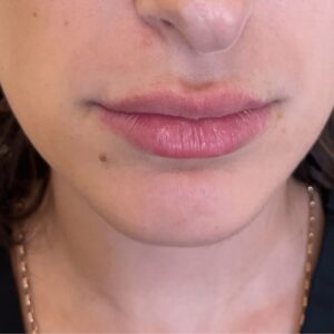 After Image: Lip Filler
