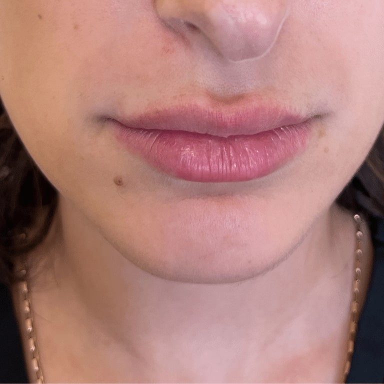 After Image: Lip Filler - front
