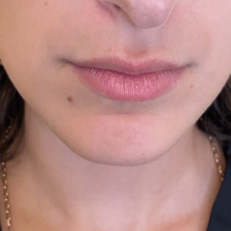 Before Image: Lip Filler - front