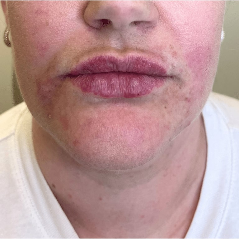 After Image: Lip Filler - front