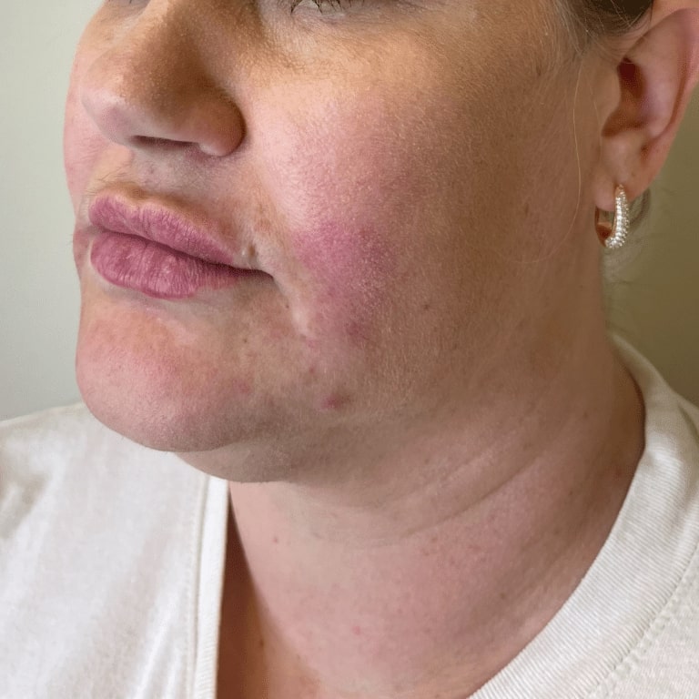 After Image: Lip Filler - left-front-oblique