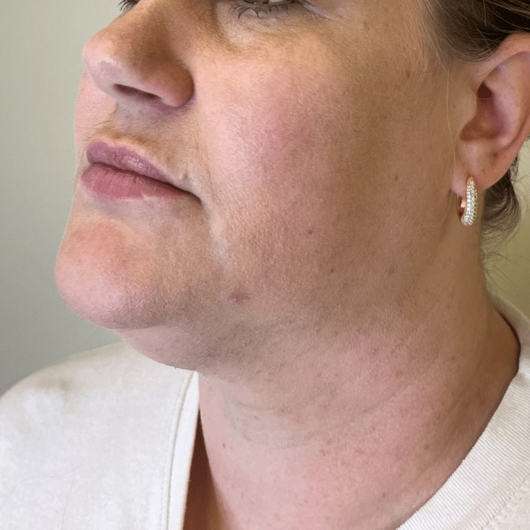 Before Image: Lip Filler - left-front-oblique