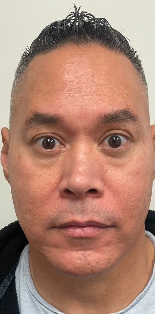 After Image: Facial Filler & Botox - front