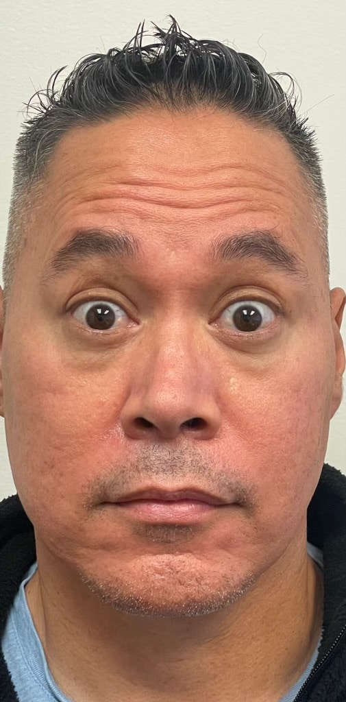 Before Image: Facial Filler & Botox - front