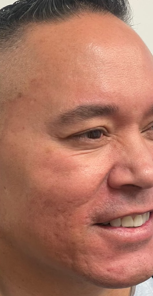 After Image: Facial Filler & Botox - right-front-oblique