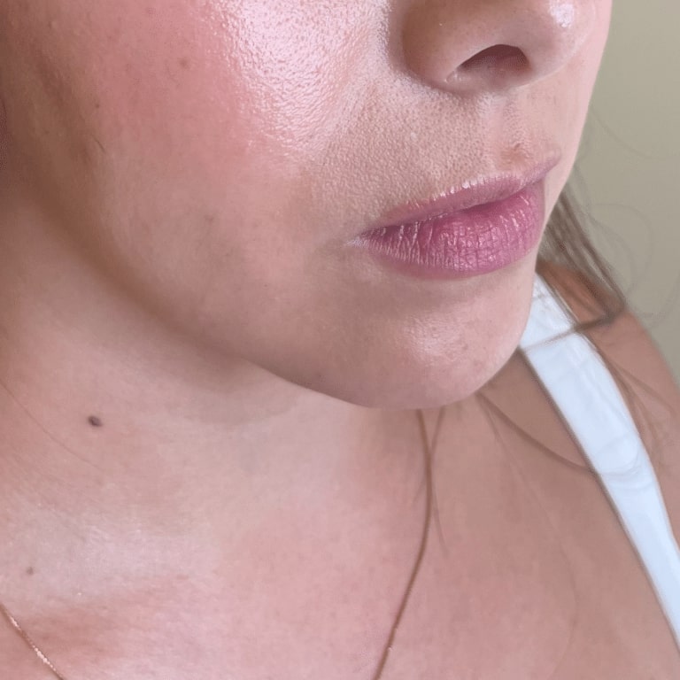 Before Image: Lip Filler - right-front-oblique