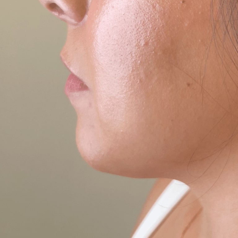 Before Image: Lip Filler -