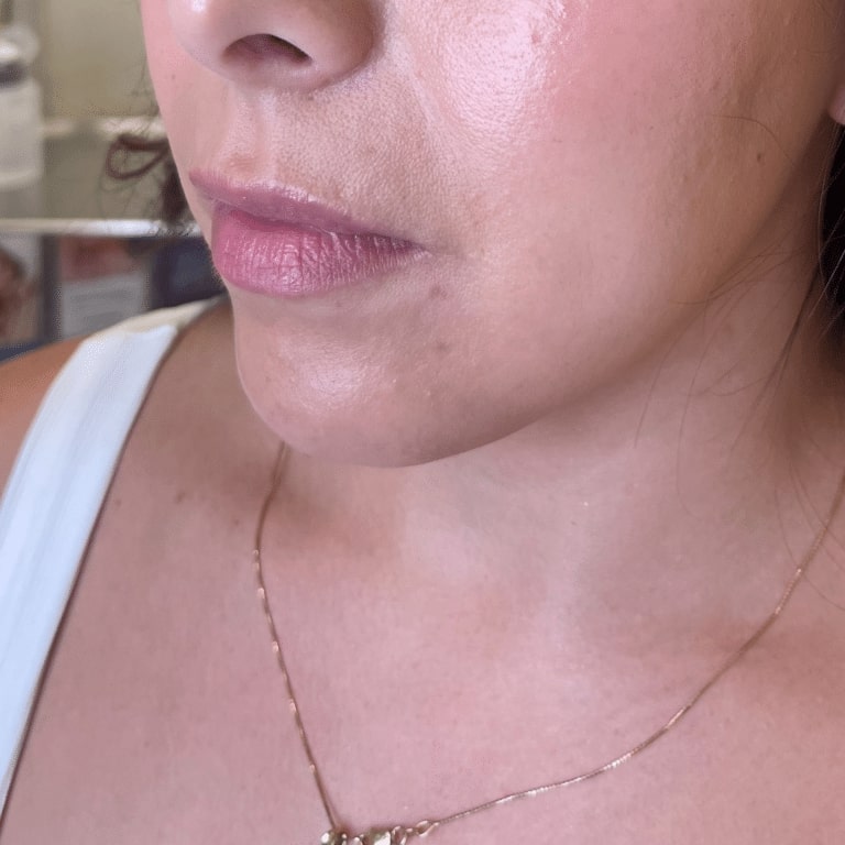 After Image: Lip Filler - left-front-oblique