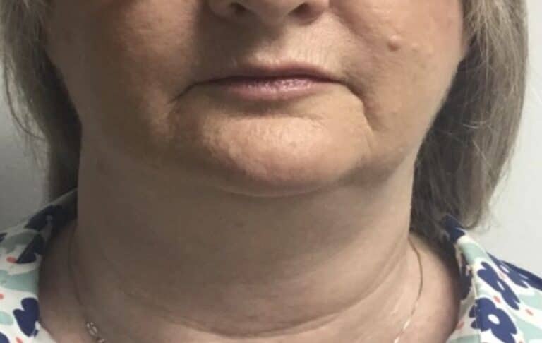 After Image: Patient 1 CoolSculpting - front