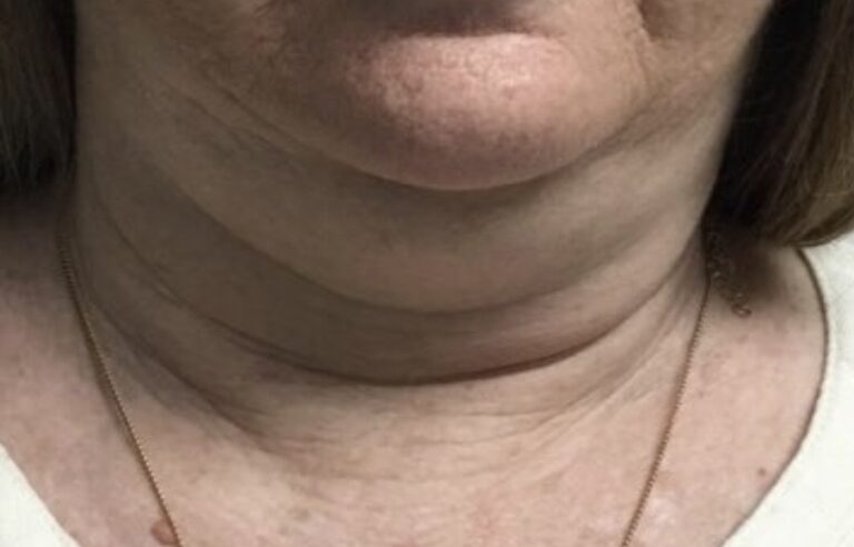 Before Image: Patient 1 CoolSculpting - front