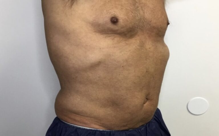 After Image: Patient 2 CoolSculpting - right-side