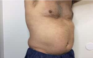Before Image: Patient 2 CoolSculpting