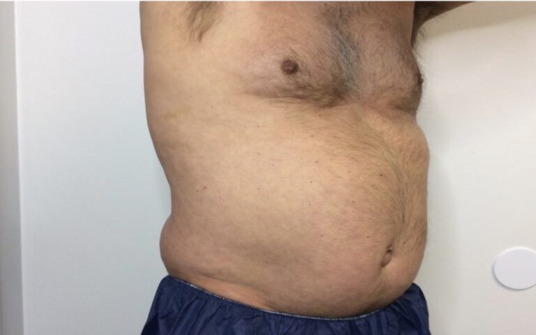 Before Image: Patient 2 CoolSculpting - right-side