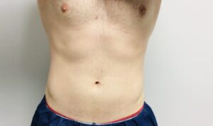 After Image: Patient 3 CoolSculpting
