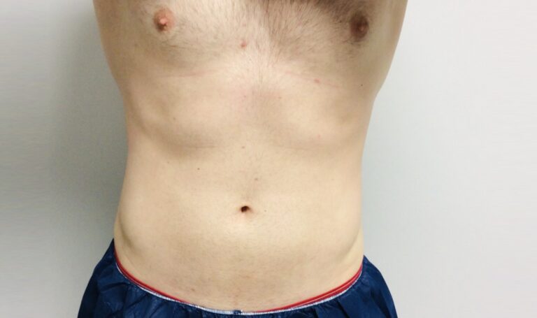 After Image: Patient 3 CoolSculpting - front