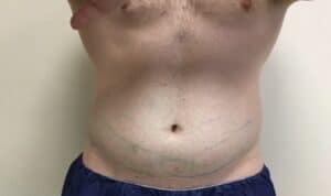 Before Image: Patient 3 CoolSculpting