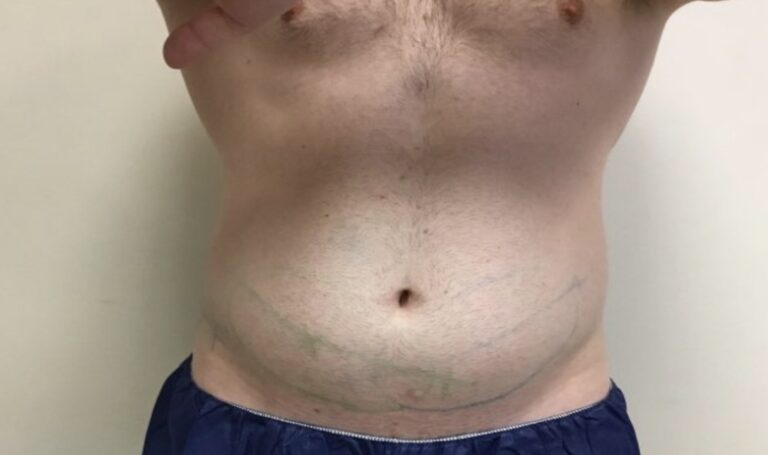 Before Image: Patient 3 CoolSculpting - front