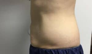 After Image: Patient 4 CoolSculpting