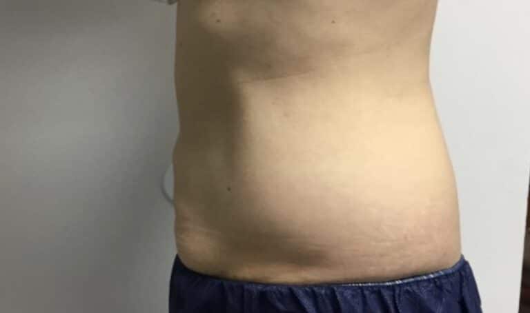 After Image: Patient 4 CoolSculpting - left-side