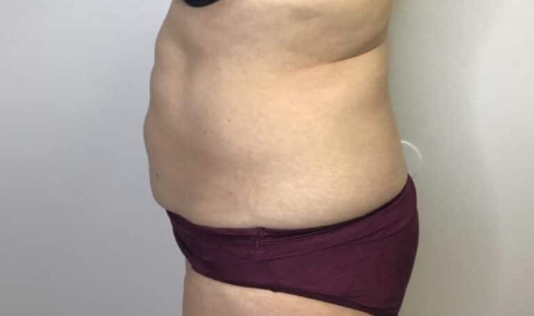 Before Image: Patient 4 CoolSculpting - left-side