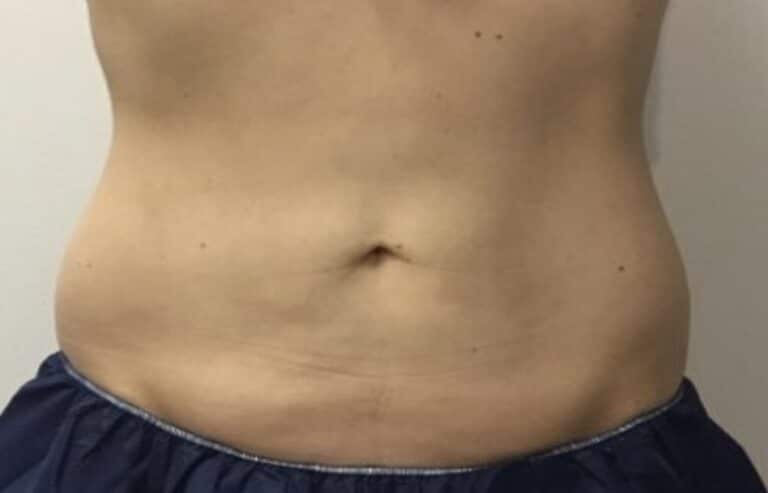 After Image: Patient 5 CoolSculpting - front