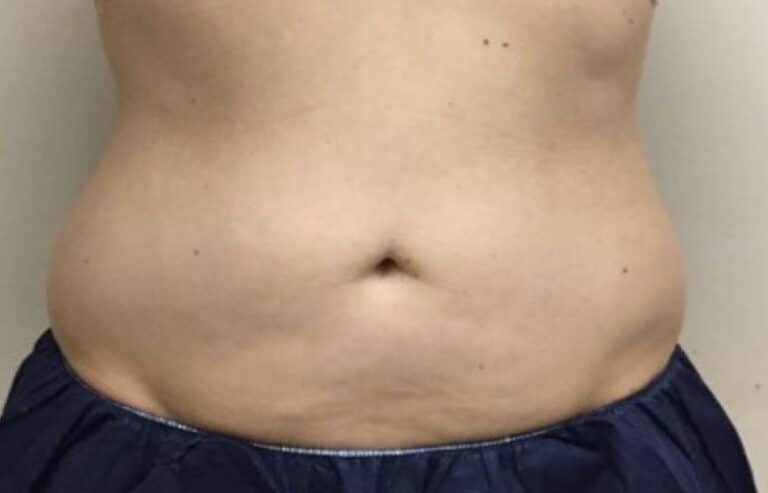 Before Image: Patient 5 CoolSculpting - front